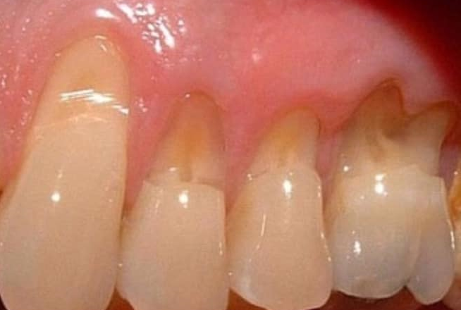 MÒN CỔ RĂNG - BIỆN PHÁP PHÒNG NGỪA VÀ XỬ TRÍ